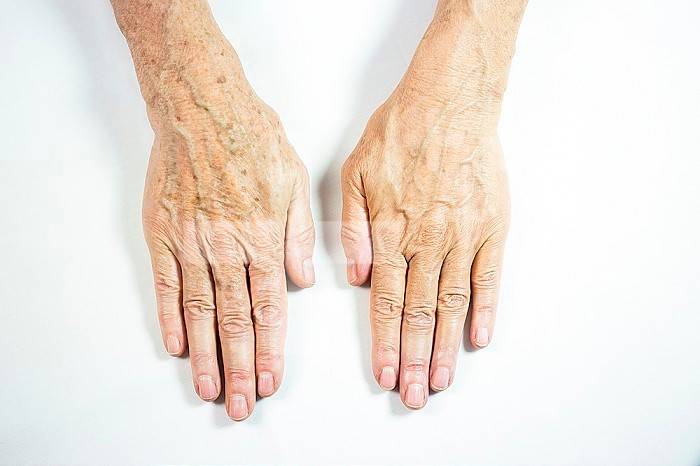 One hand with spots of old age and the other one laser treated.