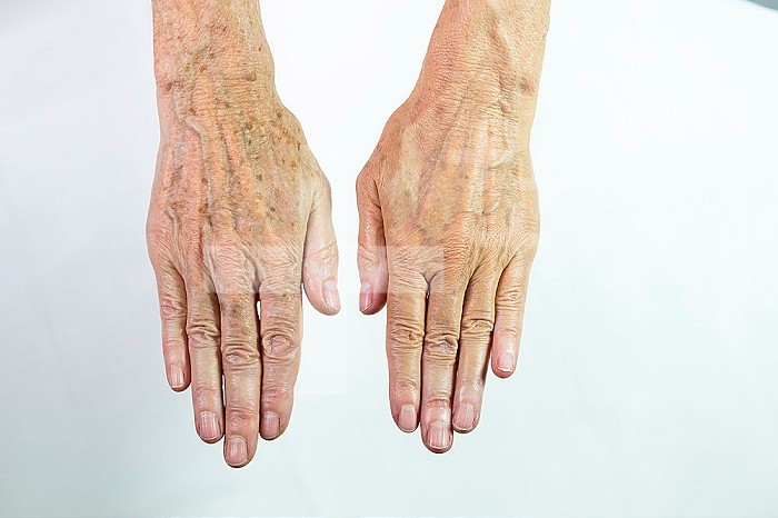 One hand with spots of old age and the other one laser treated