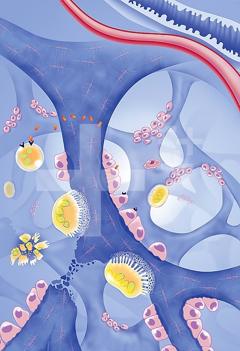 Site of action of drugs in the treatment of osteoporosis. View of bone trabeculae of spongy bone (blue). Osteoclasts (yellow) destroy the bone, while osteoblasts (roses) make bone. On the left is the osteoclast cycle with, from top to bottom, an osteoclast precursor with RANK receptors, a mature osteoclast destroying the bone, an osteoblast in apoptosis. On the right a pre-osteoblast. A mature osteoblast makes RANK-L that will bind to the pre-osteoclast RANK receptor. Estrogen binds to the estrogen receptor of osteoblasts to inhibit osteoclast activity. Top right, a blood vessel and a bowel in sections.