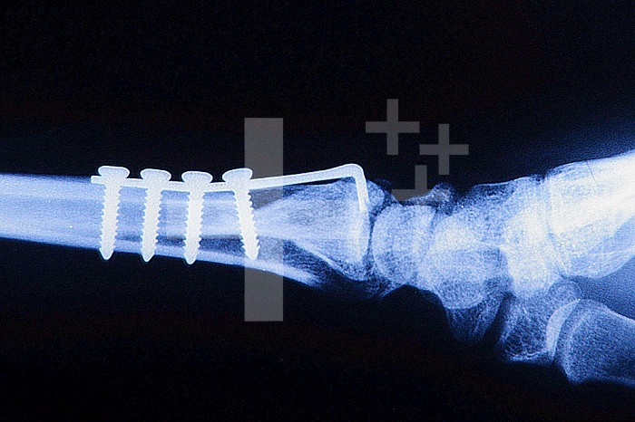 Osteosynthesis on fracture of the radius using screws and a plate placed internally. Osteosynthesis is used to maintain the parts of the fractured bone in their original position and to allow good bone consolidation. Sagittal radiograph of the wrist.