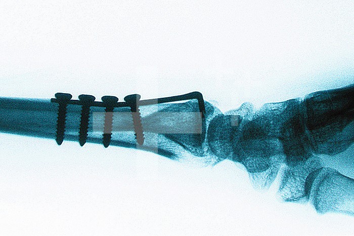 Osteosynthesis on fracture of the radius using screws and a plate placed internally. Osteosynthesis is used to maintain the parts of the fractured bone in their original position and to allow good bone consolidation. Sagittal radiograph of the wrist.