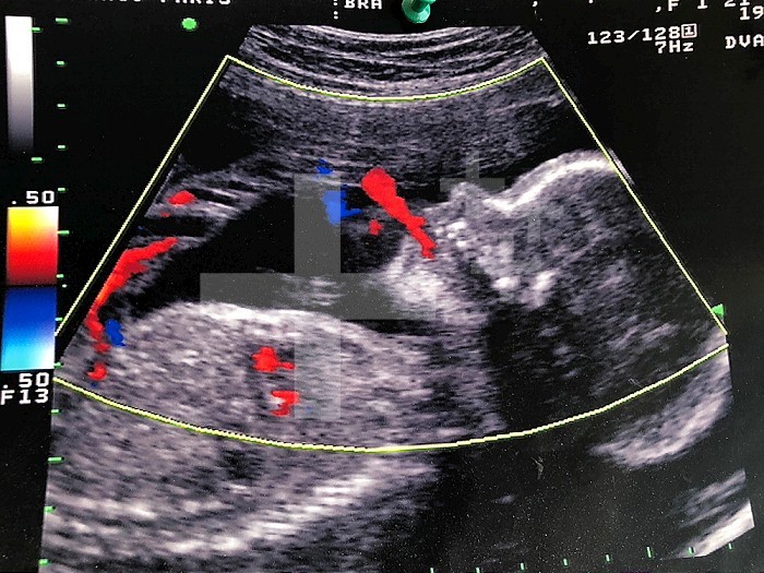 Fetal ultrasound of a fetus. Its head is in profile and it expels amniotic fluid from its mouth. The heart is visible in the center as two small red spots, on the left the umbilical cord with its artery in red and its vein in blue.