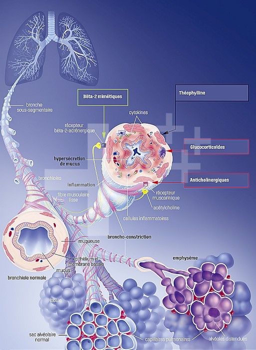 Chronic obstructive pulmonary disease COPD and its treatments. In the upper left, the lungs with the bronchial tree in transparency, hence a sub segmental bronchus in zoom. A left sectioned bronchiole is normal. The right sectioned bronchiole exhibits bronchoconstriction with hypersecretion of mucus, inflammatory cells producing cytokines in the mucosa. At the bottom the pulmonary lobules. On the left the alveolar sacs are normal, on the right, an emphysema seen in section shows the distended cells.