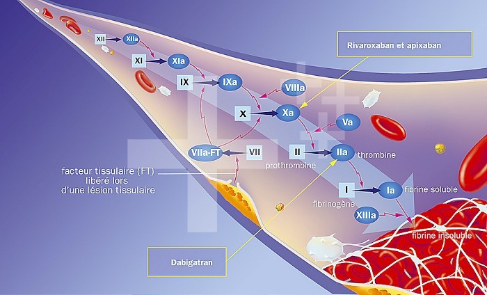 Intervention of anticoagulants on the coagulation cascade. Blood vessel with coagulation factors inducing the coagulation cascade to the clot at the bottom right. An atheroma plaque (yellow-orange) on the vessel wall releases tissue factor VII. Around the coagulation cascade, red blood cells, platelets (white) and cholesterol (yellow spheres)