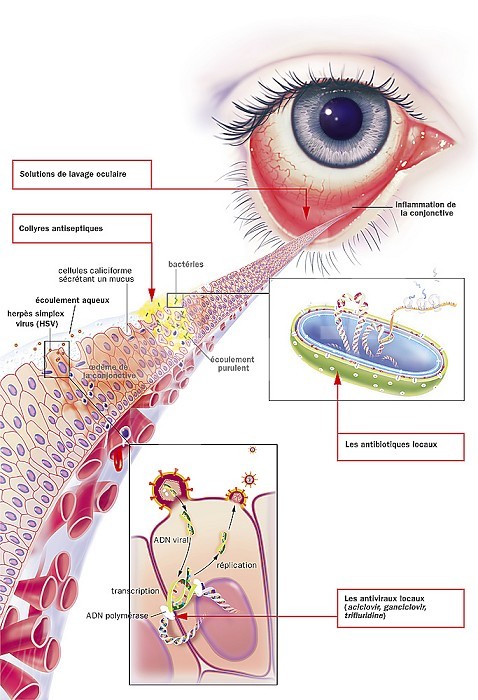 Infectious conjunctivitis and its treatments. View of an eye with inflammation of the conjunctiva. Zoom on the conjunctiva with up and down 1 bacterial infection (green) and 1 viral infection (red-orange). In yellow, purulent flow due to the presence of bacteria (green), the cells of the conjunctiva are destroyed. Goblet cells secreting mucus and edema of the conjunctiva in the zone infected by the virus. Right from top to bottom, a bacterium seen in section, a window with an infected conjunctive cell (Herpes Simplex virus) detailing the process of viral replication transcription of viral DNA, DNA polymerase, viral replication