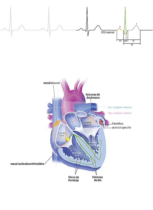 Atrial fibrillation, supraventricular arrhythmia in the heart and treatments. Atrial fibrillation is a supraventricular arrhythmia. In the design of a heart seen in section, the stasis of the flow induced by the anarchic contractions of the atria led to the formation of a clot (thrombus) in the left auricle. The electrical conduction of the heart starts at the sinus node of Keith and Flack (orange), spreads to the auricles and the atrioventricular node (yellow), then the bundle of His and the fibers of Punkinje (green). At the top of the image a normal ECG (electrocardiogram) shows the different colors corresponding to the electrical conduction on the heart. Venous and arterial blood flow is represented in transparency.