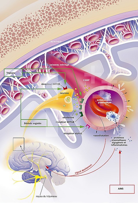 The migraine attack and its treatments. At the top, a section of the skull lined by the meninges (the dura mater, the arachnoid united to the pia mater by spans, the pia mater, membrane vessel which directly covers the brain). one of the meningeal vessels is enlarged. Below, a cut of the brain with the nucleus of the trigeminal nerve (yellow) which will give, from top to bottom, the ophthalmic nerve, the maxillary nerve, the mandibular nerve. The latter will abandon a meningeal branch (yellow zoom) whose synaptic contact is seen with the 5HT1B receptors (dark green) of the meningeal vessel. The crisis is caused by the activation of the trigemino-vascular system, (brain and neuron of the meningeal branch), inducing on the one hand the release of vasodilator peptides (serotonin (green beads) and CGRP (red-orange beads)), and on the other hand plasma extravasation and inflammation. On the neuron, a 5HT1D receptor (red) targets ergot derivatives as well as the alpha-1 (pink) receptor on the vessel.