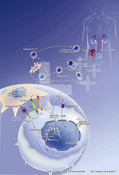Mechanisms of rejection by presentation of graft antigens to lymphocytes. Top right, silhouette of a man with a kidney transplanted into his right iliac fossa. The antigen presenting cell (CPA) (in pink, in the center and in the magnifying glass on the lower left) will present the graft antigen to the T8 (dark blue nucleus) and T4 (medium blue nucleus) lymphocytes. The T4 lymphocyte will produce interleukins (IL2, IL6) which will in turn stimulate the production of antibodies via the B cell (purple nucleus) and NK macrophage cells (green core). The T8 lymphocyte will be cytotoxic and cause lysis of the graft cells. The magnifying glass at the bottom left details the presentation of the graft antigen and the different receptors CD 3 (yellow), CD4 (white), CD28 (green) and CD40 (orange) in connection with CPA.