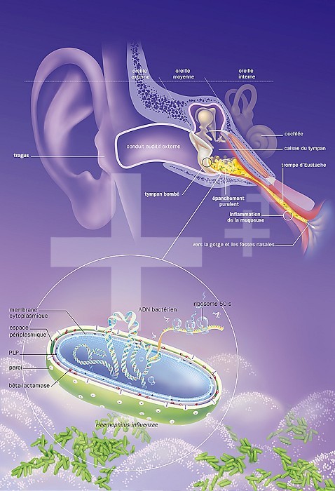 Middle ear with purulent effusion, bulging tympanum, Haemophilus influenzae bacteria. Otitis media acute. Frontal cut of the auditory apparatus passing through the outer ear and the middle ear, bulging tympanum with a purulent effusion in the middle ear and inflammation of the mucosa. Below, zoom in on the mucosa with a Haemophilus influenzae bacteria seen in section allowing to see the different layers of the wall with the betalactamases of the periplasmic space and the PBPs of the cytoplasmic membrane bacterial DNA with the ribosomes.