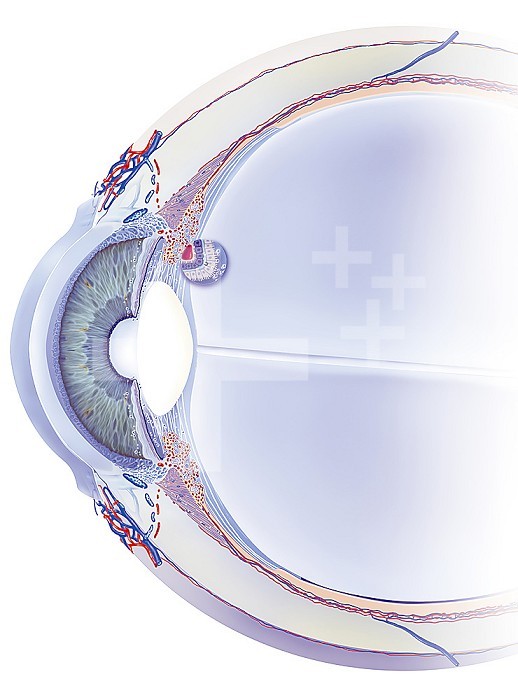 Schlemm canal, trabeculum, aqueous humor, treatments. Sagittal section of the eye with, behind the cornea, the anterior chamber, the iris and the crystalline lens and then the chamber. The aqueous humor produced by the ciliary bodies (connected by the suspensory ligaments to the lens) passes through the pupil and is evacuated via the trabecular meshwork (at the junction between the cornea and the iris) through Schlemm´s canal to the circulation. venous.