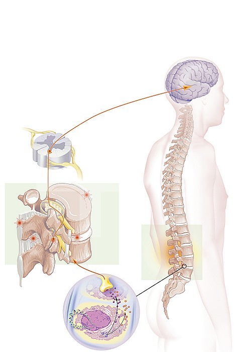 Brain and spine in situ, lumbar nociceptors, nerve impulses, treatment. Anatomical situation of lumbago on a silhouette. On the left, details of the path of nerve impulses from nociceptors located at the level of the vertebral cartilages (magnifying glass), intervertebral disc, anterior longitudinal ligament, supraspinous ligament or interspinous ligaments. From there he climbs to the brain through the posterior horn of the spinal cord. The magnifying glass shows cartilage cells producing cyclooxygenase (COX) promoting the synthesis of prostaglandins E2 mediating inflammation and pain as well as A2 thromboxanes.
