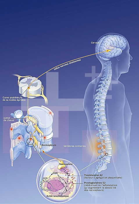 Brain and spine in situ, lumbar nociceptors, nerve impulses, treatment. Anatomical situation of lumbago on a silhouette. On the left, details of the path of nerve impulses from nociceptors located at the level of the vertebral cartilages (magnifying glass), intervertebral disc, anterior longitudinal ligament, supraspinous ligament or interspinous ligaments. From there he climbs to the brain through the posterior horn of the spinal cord. The magnifying glass shows cartilage cells producing cyclooxygenase (COX) promoting the synthesis of prostaglandins E2 mediating inflammation and pain as well as A2 thromboxanes.
