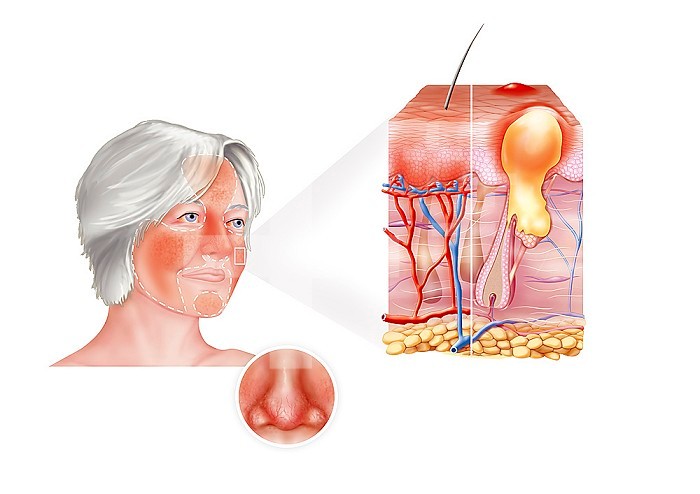 Representation of the localization of the rosacea on a female face..Spresented as the cut of skin, left part, rosacea, dilatation and proliferation of the subepidermal vessels..On the right part of the cut is represented the form rosacea acne or papulopustular, with a papule in the background and a pustule in the foreground. The zoom on the nose represents the rhinophyma, thickening of the skin of the nose which gives it an inflated and red appearance due to the hypertrophy of the blood vessels and sebaceous glands, many in this place.