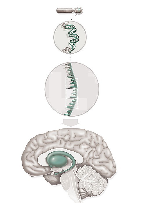 Medical illustration representing Huntington´s disease, a genetic disorder involving the HD gene (Huntington Disease) of chromosome 4 with abnormal repetition of a sequence of 3 bases CAG (cytosine, adenine, guanine). This HD gene normally has a role protection of the brain but with this abnormal repetition it leads to the degeneration of neurons in the striatum (putamen and caudate nucleus) involved in the motor, cognitive and behavioral functions of the brain.