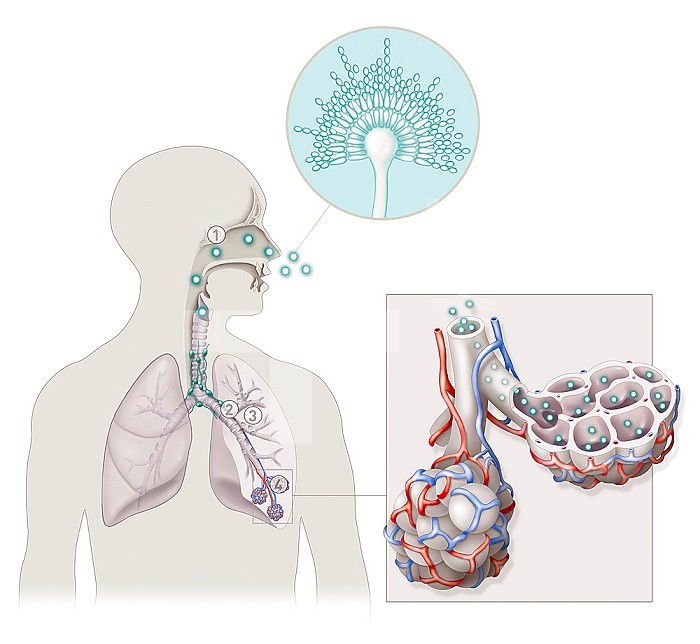 The 4 main types of aspergillosis disease.These infections are caused by inhaling the spores of a small fungus called aspergillus, most commonly aspergillus fumigatus. They can cause: (1) aspergillus sinusitis, infection local sinus may have an invasive form in immunocompromised patients. (2) allergic bronchopulmonary aspergillosis, inflammation and obstruction of the bronchi mainly affecting asthmatic or cystic fibrosis patients with symptoms identical to those of asthma. (3) an aspergilloma, a mycelial ball developing in a pulmonary cavity caused by another pathology such as tuberculosis or sarcoidosis. (4) invasive aspergillosis, which spreads through the pulmonary blood pathways to other organs, affecting mainly immunocompromised patients.