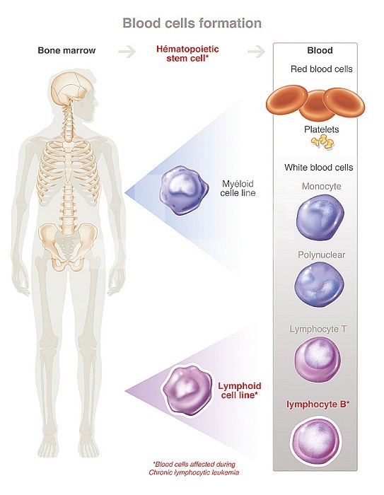 Blood cells (hematopoiesis) form from the bone marrow of flat bones. These hematopoietic stem cells give two lines. The myeloid line differentiates into red blood cells, platelets, monocytes and polymorphonuclear cells. The lymphoid line is differentiated into T lymphocytes, B lymphocytes. In this drawing, indicate which immune cells are affected during chronic lymphocytic leukemia (cancer of the stem cells which make blood in the bone marrow): hematopoietic stem cells, the lineage lymphoid, including B lymphocytes