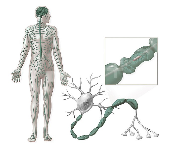 Guillain-Barre syndrome, damage to peripheral nerves. The peripheral nerves transmit information from the brain or spinal cord (central nervous system) to muscles or organs. During Guillain Barre syndrome, the transmission of information is slower due to inflammatory damage (demyelination) of the spinal roots and nerves. The inflammatory process seems to be of immuno-allergic origin and triggered by a viral attack. Reaching the roots and nerves results in the rapid but progressive installation of diffuse symmetrical flaccid paralyzes affecting the limbs and the face.