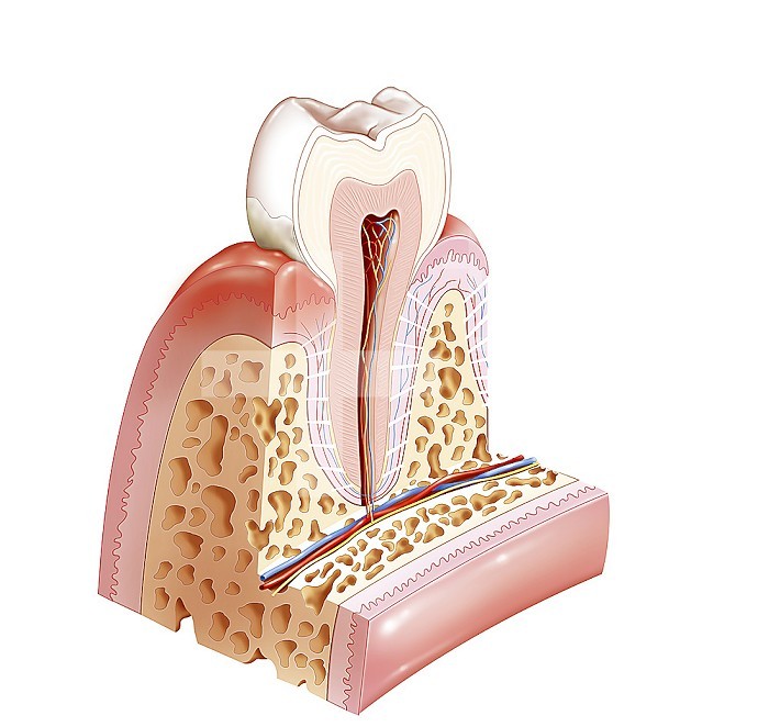 Gingivitis is a mild inflammation of the gum. In this drawing, it is represented on the right part of the gum, the red part, which characterizes the inflammation with swelling of the gum. It is associated here with a plaque of tartar on the periphery of the lower part of the dental crown and the upper part of the collar. Gingivitis can quickly spread to the underlying tissues and turn into periodontitis which is not the case in this drawing.