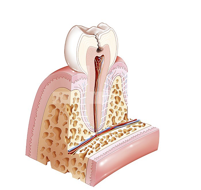 Decayed tooth with dentin damage. Dentin is the area shown in pinkish beige. Here we are in stage 2 of the tooth being affected by tooth decay. This implies a sensitivity of the tooth to hot and cold.