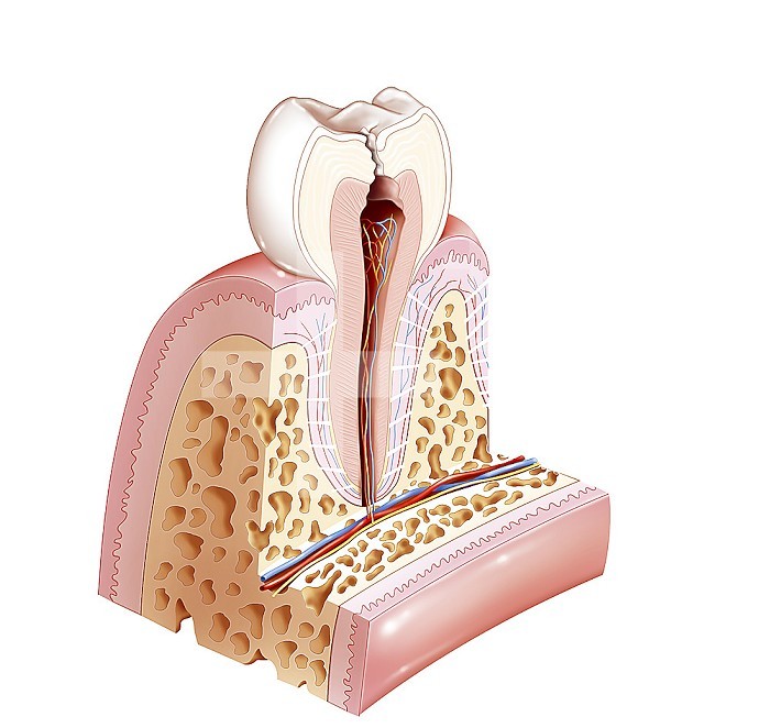 Dental pathology with caries reaching the pulp. The pulp is the central area of the tooth, the endodont. She is shown here in reddish brown. It is also called pulp chamber, coronary pulp or cameral pulp for the central part of the crown. The central part in the root is called the root pulp. Here we are in stage 3 of the tooth being affected by dental caries. the pulp contains the vessels and nerves of the tooth and gives it its vitality and sensitivity. This is why when it is affected by caries it triggers a toothache.