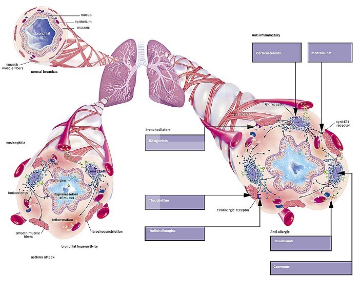 Asthma, Normal bronchiole, asthmatic bronchiole with bronchoconstriction, hypersecretion, treatments. Representation of the lungs with the bronchial tree from which 3 zooms depart. Above left, a healthy bronchiole, below, two asthmatic bronchioles. An allergen (green star) triggers the asthma attack by activating lymphocytes producing IgE (green Y) causing the degranulation of mast cells (purple) which release leukotrienes (black beads) and cytokines (blue beads) mediating inflammation of the mucous membrane which leads to bronchoconstriction of smooth muscle fibers, hypersecretion of mucus and obstruction of the respiratory tract.