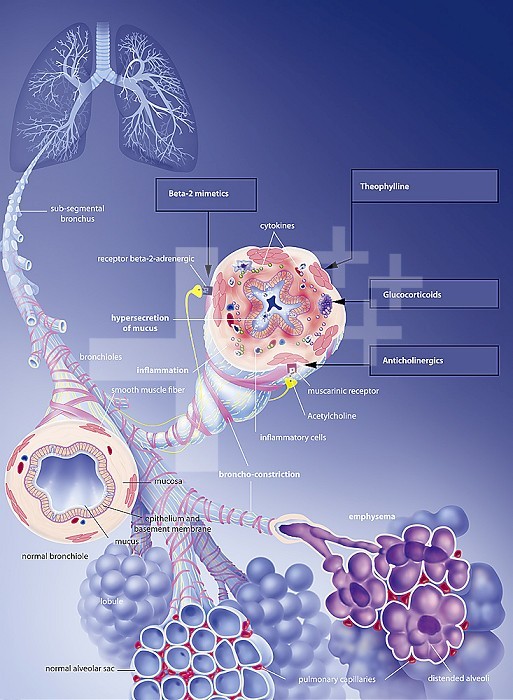Chronic obstructive pulmonary disease COPD and its treatments. In the upper left, the lungs with the bronchial tree in transparency, hence a sub segmental bronchus in zoom. A left sectioned bronchiole is normal. The right sectioned bronchiole exhibits bronchoconstriction with hypersecretion of mucus, inflammatory cells producing cytokines in the mucosa. At the bottom the pulmonary lobules. On the left the alveolar sacs are normal, on the right, an emphysema seen in section shows the distended cells.
