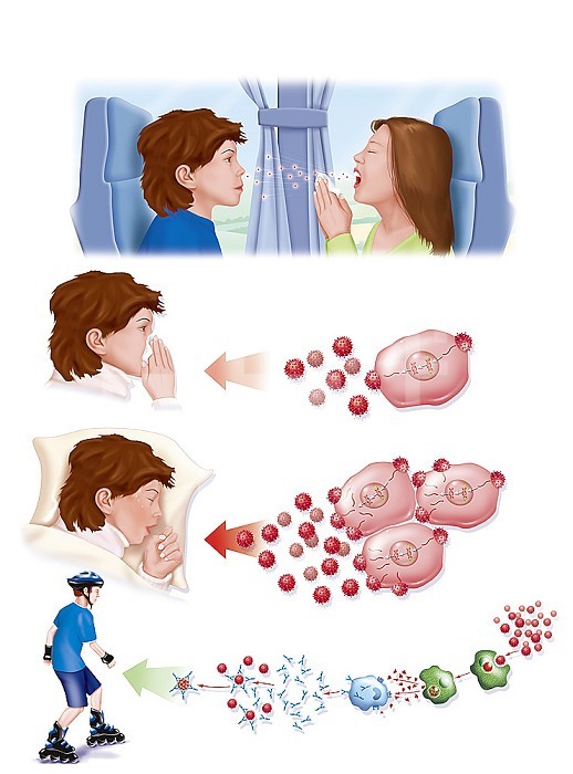 Replication of the cold virus until healing. The story begins with a sick child who coughs and infects the boy in front of her. The virus in the boy´s body uses lymphocytes to replicate. It enters the cell, deposits its viral RNA there which transforms into viral DNA. The latter attaches to the DNA of the lymphocyte which will reproduce the different parts of the virus including its viral DNA, replicating the virus in large numbers. The boy begins to cough too. Then the viruses replicate more and more, the boy has a fever and sweats. His immune system is activated. Macrophages (green cells) will phagocyte virus and infected cells, and trigger the production of antibodies (blue Y) by other lymphocytes (blue cells) which will attach to viruses in order to destroy them. After a few days, the invasion is under control and the boy can resume his normal life.