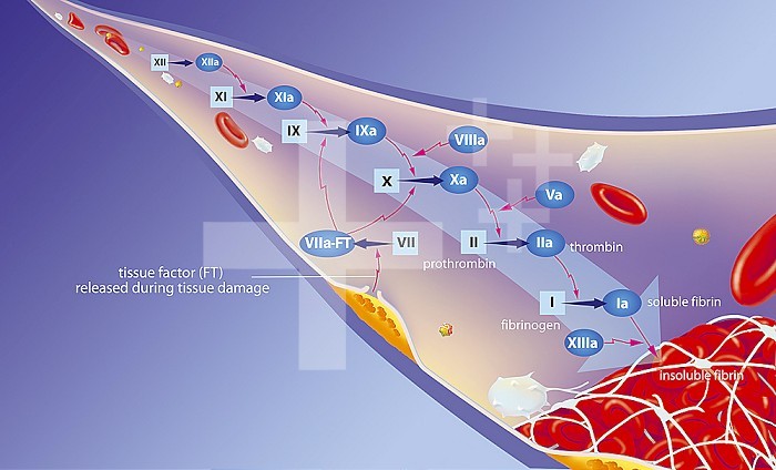 Intervention of anticoagulants on the coagulation cascade. Blood vessel with coagulation factors inducing the coagulation cascade to the clot at the bottom right. An atheroma plaque (yellow-orange) on the vessel wall releases tissue factor VII. Around the coagulation cascade, red blood cells, platelets (white) and cholesterol (yellow spheres)
