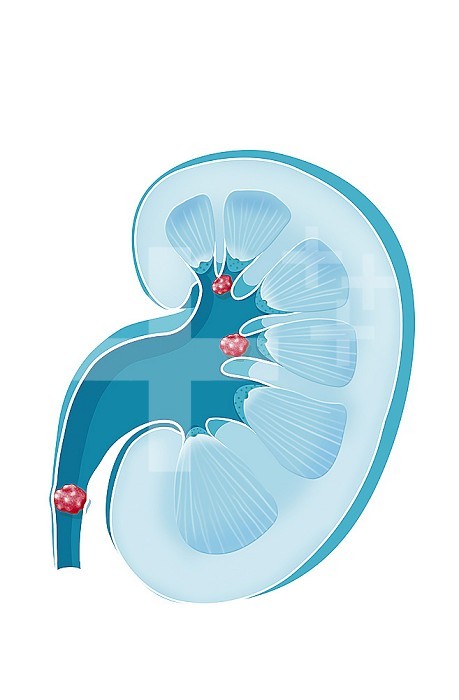 Kidney stone, urolithiasis, lithiasis disease. Kidney stone is a condition that affects the kidney shown in blue. These are small pebbles (in red) of variable size which are produced by the kidneys at the level of the renal cavities. They can remain in the cavities. We see two at the level of the chalices on this drawing. Or they can migrate along the ureter. In 70% of cases, kidney stones are eliminated in the urine. But in some cases, they can get stuck in the ureter as illustrated in this drawing at the bottom left and trigger nephritic colic.