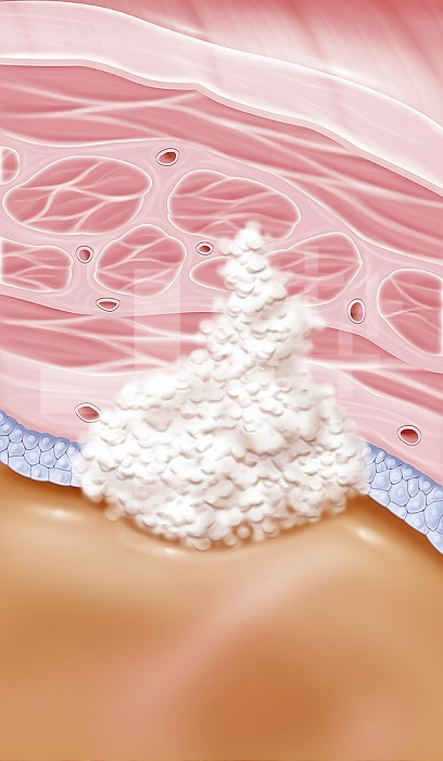Inventive bladder cancer, stage II, muscle damage. This illustration shows a zoom at the level of the bladder wall with all its structures. From bottom to top we have the bladder cavity, the epithelium (bluish gray cells), the connective tissue, the muscle consisting of three layers and finally the tissue that surrounds the bladder, here the parietal peritoneum. A stage II invasive cancer tumor is visible in this white drawing. The tumor invades the bladder muscle. This stage II is divided into two stages. In the T2a stage, the tumor reaches the lower half of the bladder muscle. While in the T2b stage, the tumor reaches the outer half of the bladder muscle. So in this drawing, we have a T2b stage tumor. - Restriction : Exclusive to pharmaceutical laboratories in Belgium. from 04/26/2020
