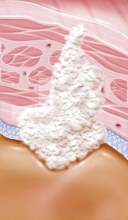 Inventive bladder cancer stage III, involvement of adjacent tissues. This illustration shows a zoom at the level of the bladder wall with all its structures. From bottom to top we have the bladder cavity, the epithelium (bluish gray cells), the connective tissue, the muscle consisting of three layers and finally the tissue that surrounds the bladder, here the parietal peritoneum. An invasive stage III cancerous tumor is visible in this white drawing. The tumor invades the tissue surrounding the bladder. In this drawing, the tumor invades the tissue that envelops the upper wall of the bladder, therefore the parietal peritoneum. This stage III is divided into three stages. In the T3a stage, the tumor has invaded neighboring tissue outside the bladder but not the pelvic wall or the abdominal wall. Or the cancer has spread to 1 lymph node in the pelvis. While in stage T3b, the cancer has spread to at least 2 lymph nodes in the pelvis or to at least 1 common iliac lymph node located just above the pelvis. Finally in stage T4a, there is invasion of neighboring organs (prostate in men and uterus and / or vagina in women. Or the cancer has spread to the lymph nodes further away from the bladder. - Restriction : Exclusive to pharmaceutical laboratories in Belgium. from 04/26/2020