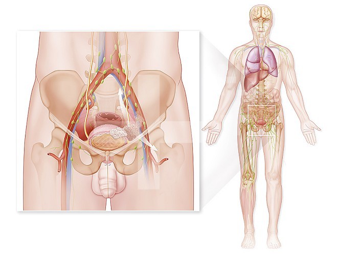 Stage IV bladder cancer in humans, tumor invasion with metastases. The illustration to the right of the drawing represents the general anatomy in a male silhouette in an anatomical position from the front. It shows the brain, lungs, heart, liver, bladder, pelvic bone and lymphatic systems. While the skeleton, the digestive system, the muscular system and the arteriovenous network are just suggested. This illustration highlights the sites of target organs that may be affected by metastases from stage IV bladder cancer. It is therefore a question of the brain, the lungs, the liver, the bones in which dis secondary cancers can develop. From the bladder, zoom in on the left side of the drawing, showing stage IV bladder cancer (primary cancer). The bladder is shown in section in the pelvic cavity to show the extent of tumor invasion. The tumor invaded the entire wall of the bladder and spread inside and beyond outside into the pelvic cavity. The vessels are affected, as well as the lymphatic system. Metastases can then at this stage migrate via the arterial system to other organs. They will then become dormant metastases and may cause secondary cancers in the following organs: brain, lungs, heart, liver. - Restriction : Exclusive to pharmaceutical laboratories in Belgium. from 04/26/2020