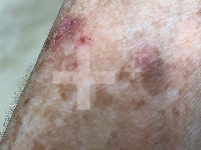 Age spots on the forearm of a 72-year-old woman.