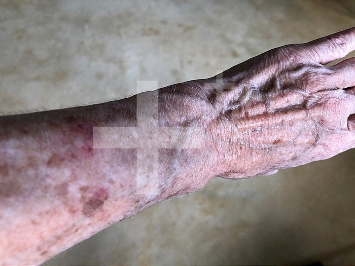 Age spots on the forearm and the hand of a 72-year-old woman.