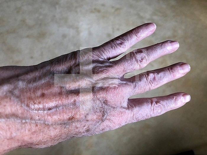 Age spots on the hand of a 72-year-old woman.