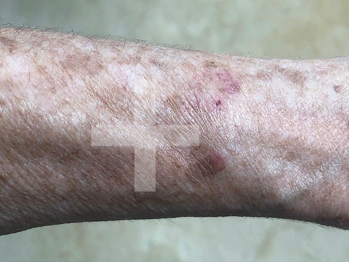 Age spots on the forearm of a 72-year-old woman.