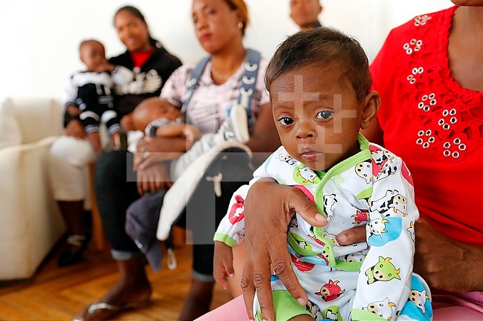French NGO Chaine de l´Espoir. Child suffering of heart disease. Antananarivo. Madagascar.