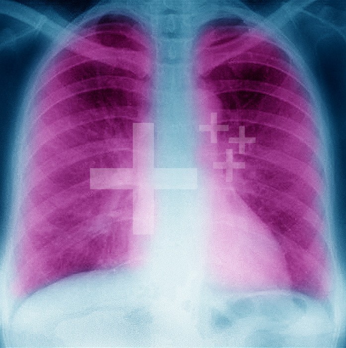 Pneumonia with radiological appearance in frosted glass, it is due to partial filling of the alveolar lumens and / or thickening of the alveolar partitions, during pneumonia with infection in an immunocompromised patient (ex COVID 19), or a demed, or hemorrhage, or lung inflammation.