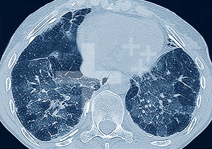 Pulmonary fibrosis (lesion of the lungs characterized by the presence of excess fibrous connective tissue). Many pathologies are involved, including conditions due to COVID 19 and interstitial lung disease. Breathing discomfort is the main symptom. Chest scanner.