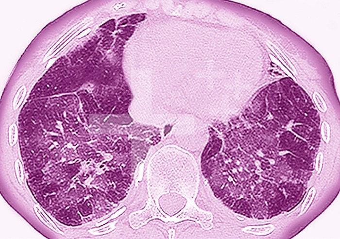 Pulmonary fibrosis (lesion of the lungs characterized by the presence of excess fibrous connective tissue). Many pathologies are involved, including conditions due to COVID 19 and interstitial lung disease. Breathing discomfort is the main symptom. Chest scanner.