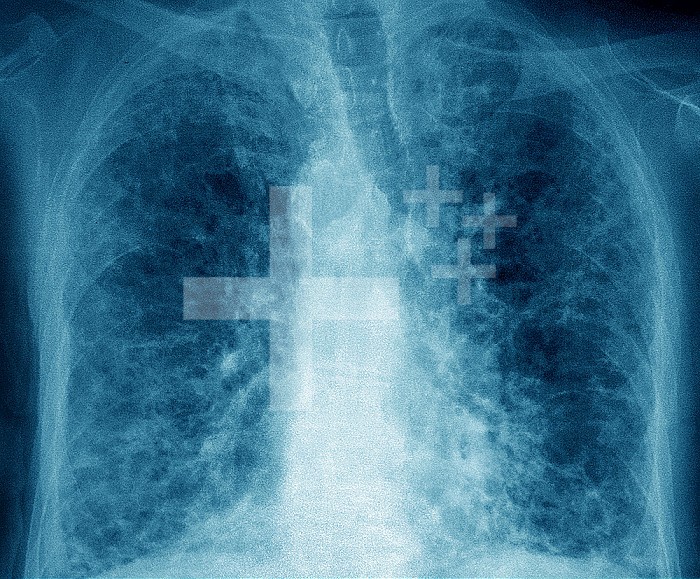 Fibrose pulmonaire (lesion des poumons caracterisee par la presence d´un exces de tissu conjonctif fibreux). De nombreuses pathologies sont en cause, parmi lesquelles les affections dues au COVID 19 et les pneumopathies interstitielles. La gene respiratoire en est le principal symptome. Radiographie thoracique.