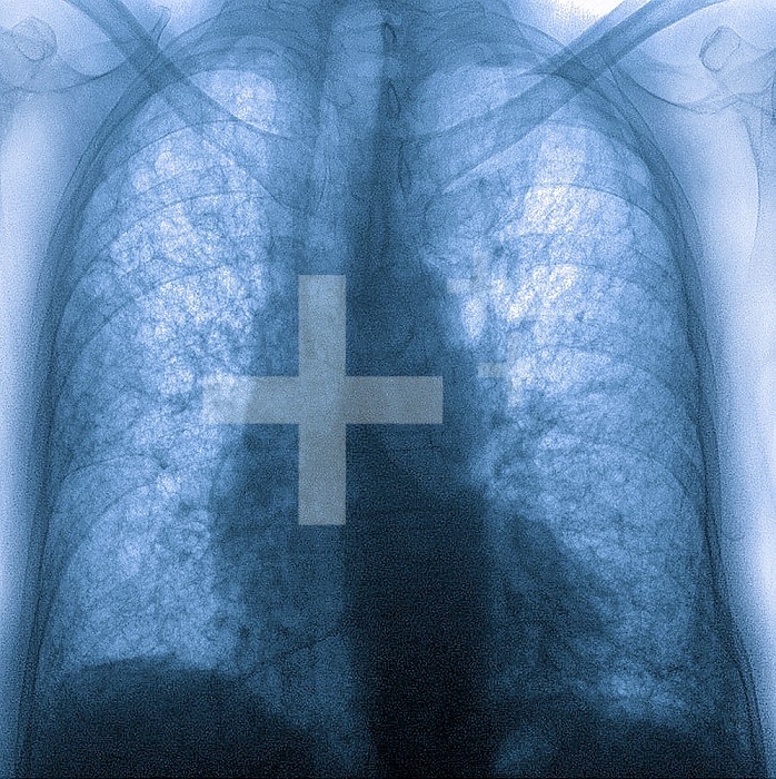Pulmonary fibrosis (lesion of the lungs characterized by the presence of excess fibrous connective tissue). Many pathologies are involved, including conditions due to COVID 19 and interstitial lung disease. Breathing discomfort is the main symptom. Chest x-ray.