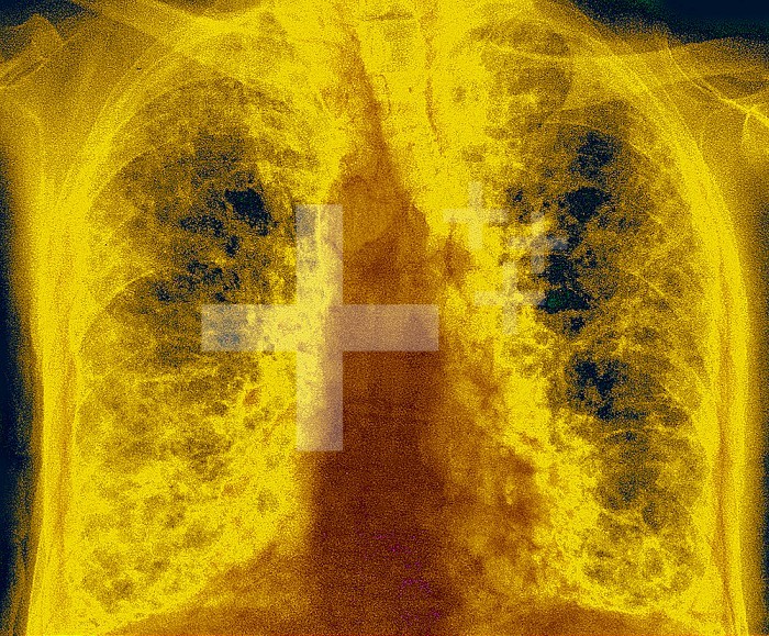 Fibrose pulmonaire (lesion des poumons caracterisee par la presence d´un exces de tissu conjonctif fibreux). De nombreuses pathologies sont en cause, parmi lesquelles les affections dues au COVID 19 et les pneumopathies interstitielles. La gene respiratoire en est le principal symptome. Radiographie thoracique.