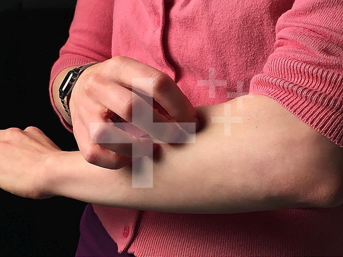 A woman scratches the skin on her forearm. There are many possible causes of itching, including allergic reactions, skin conditions, and infection. Credit: NIAID