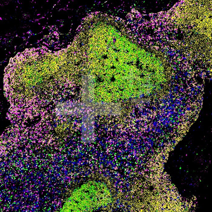 A microscopic image of a biopsied lymph node of a person with untreated HIV, showing large germinal centers containing abnormal proliferating B cells (bright green) and an accumulation of cells expressing the transcription factor T-bet (magenta) in the surrounding areas. Credit: NIAID.