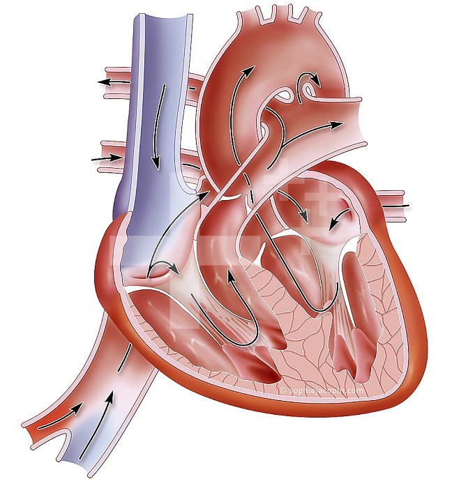 Heart of a fetus, pediatric anatomy, foramen ovale, arantius venous duct. Illustration representing the heart in a fetus, therefore before birth. Before birth, the right and left atrium communicate through the foramen ovale. This foramen closes at birth due to the pressure caused by the flow of blood. But the aortic arch also communicates with the pulmonary trunk at the level of the arterial duct. This duct closes 3 weeks after birth to become the arterial ligament. Another feature of the fetal heart is an additional blood vessel, the Arantius duct or duct. This vessel is used to transport venous blood from the placenta of the pregnant woman to the inferior vena cava of the fetus without having to pass through the liver. This helps transport oxygen from the umbilical vein much faster. The Arantius canal stops functioning a few minutes after birth. It will spontaneously close again during the first week of life and remain in the form of a residue: the venous ligament of the liver. The black arrows represent the direction of blood flow in the newborn heart. Blue and red colors indicate oxygenation of the blood. Blue represents deoxygenated blood and red represents oxygenated blood.