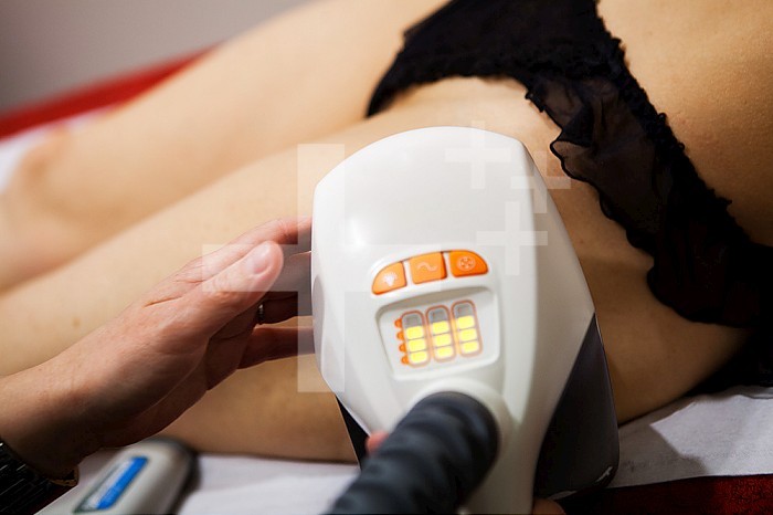 Infra-red laser treatment of cellulite.
