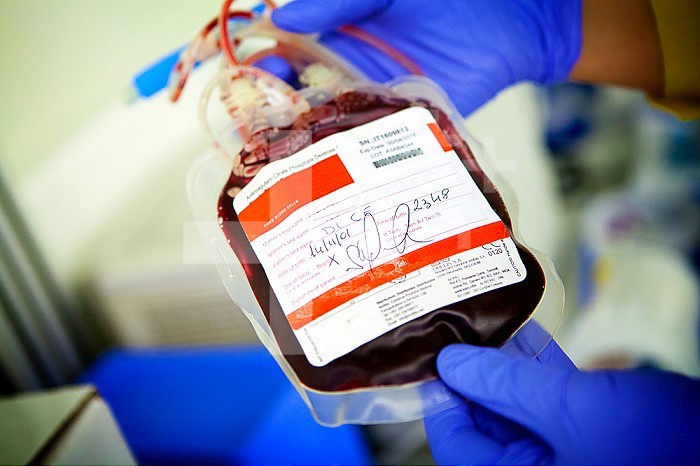 Biobank, bag containing cord blood stem cells (hematopoietic stem cells).
