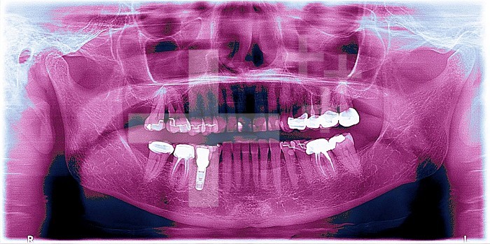 Colorized jaw x-ray. Presence of implants and dental crowns.