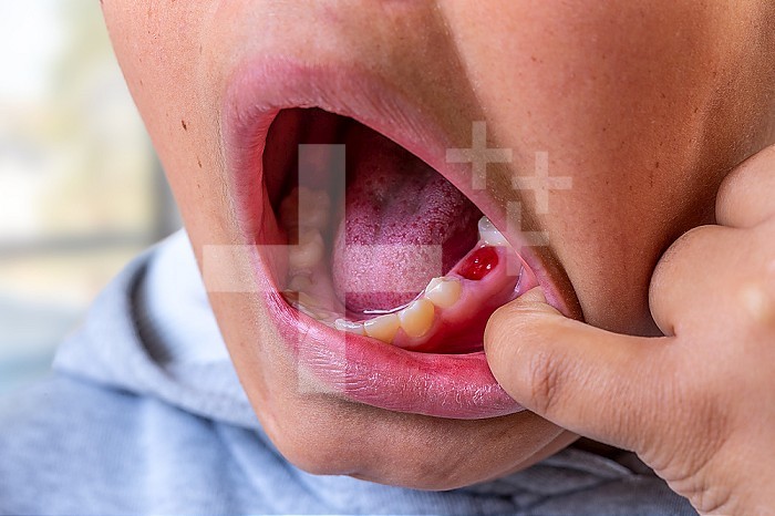 Child opening his mouth with a fallen tooth.